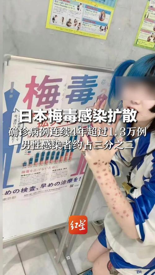 日本梅毒感染扩散