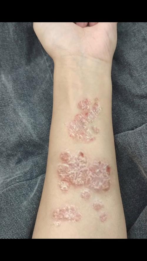 牛皮皮癣症状图片